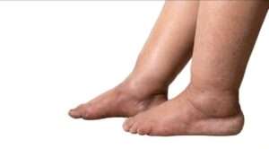 Swollen legs: A cause for concern 3 OrangeNews9 OrangeNews9